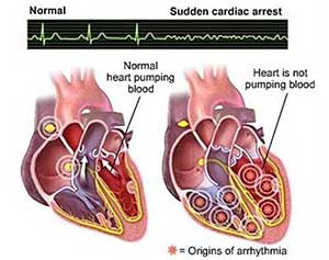Sudden Cardiac Arrest - Dr. VT Shah